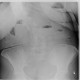 Ileus, small bowel, adhesions: X-ray - Plain radiograph